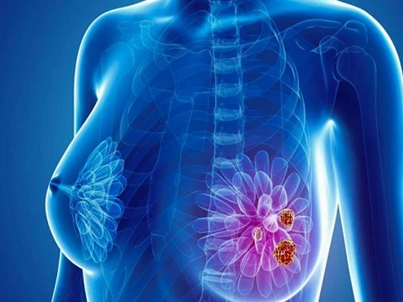 انواع فیبروکیستیک پستان