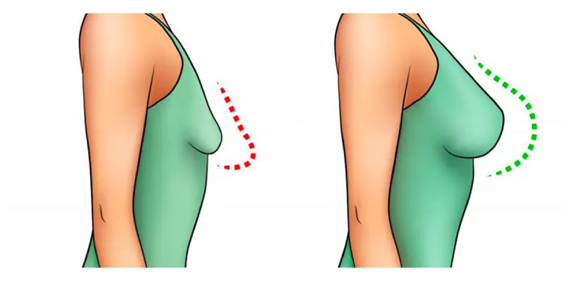 سوتین مخصوص از مراقبت های بعد از مامو پلاستی