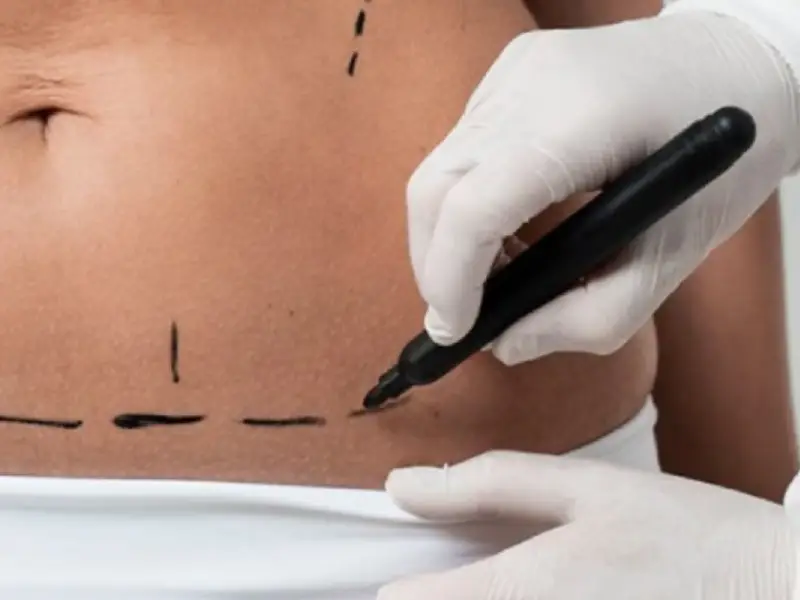 ابدومینوپلاستی در اهواز