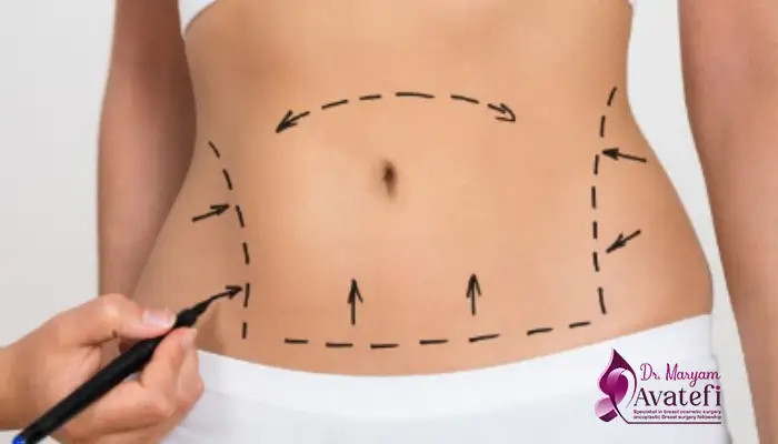 ابدومینوپلاستی