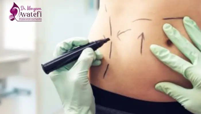 مراحل انجام ابدومینوپلاستی