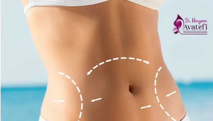 مراقبت های بعد از ابدومینوپلاستی